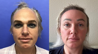 1cc Voluma to Nasolabial Depressions and Medial Cheeks, and 1cc Juvederm to Facial Rhytids and Chin Dimple
