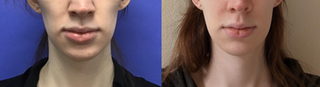 Chin Reduction and Contour
