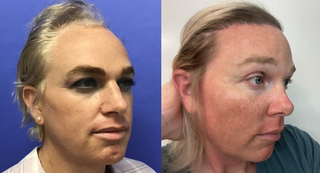 Septorhinoplasty (closed) with Cartilage Grafts and Weirs