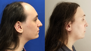 Septorhinoplasty (closed) with Cartilage Grafts and Weirs