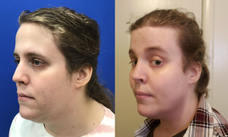 Cheek Implants (small)