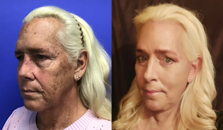 2cc Voluma to Medial Cheeks and Deep Nasolabial Creases