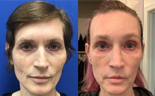 Septorhinoplasty (Closed) with Weirs, Soft Tissue Grafts and Cartilage Grafts