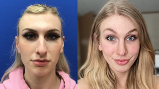Cheek Implants (small)