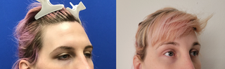 Forehead Lift, Hairline Lowering and Orbital Bony Contour