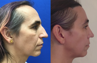 Flap Procedure