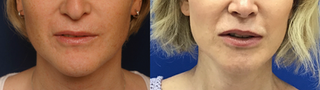 Chin Reduction and Contour