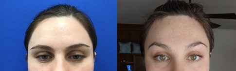 Hairline Forehead Lift and Orbital Bony Contour