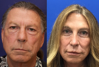 Cheek Implants