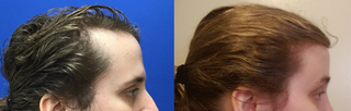 Hairline Lowering, Hairline Forehead Lift and Orbital Bony Contouring