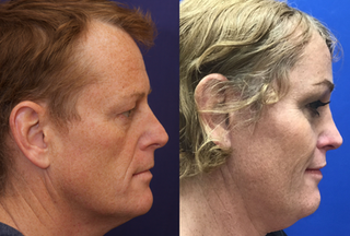 Cheek Implants