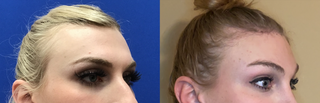 Forehead Lift, Hairline Lowering, Orbital Bony Contouring