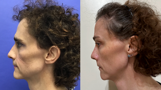 2cc Voluma to Cheeks