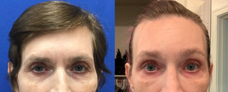 Forehead Lift, Hairline Lowering, Orbital Bony Contouring