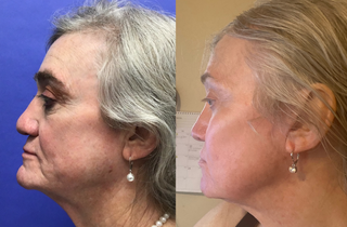 Septorhinoplasty (closed) with Cartilage Grafts and Radix Graft