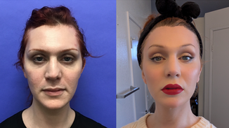 Intranasal Lip Lift with Fat Augmentation