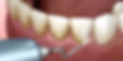 Root Planing: Deep Cleaning for Healthier Gums