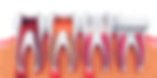 Top Reasons to Choose EZ Dental Care for Root Canal