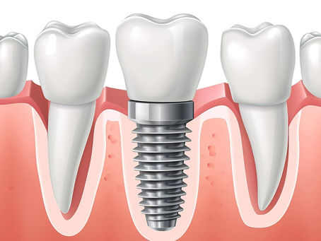 What Are Dental Implants and How Do They Compare to Dentures
