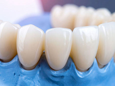 What to Expect During a Tooth Bridge Procedure in Singapore