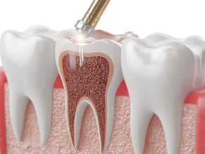 what is a root canal