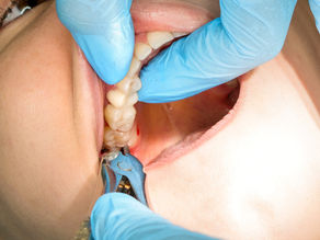 wisdom tooth extraction