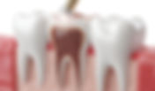 What Is Root Canal Treatment: A Clear Guide to Saving Your Tooth