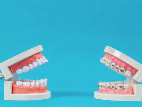 how do dental braces work