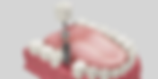 A Complete Guide to the Dental Implant Procedure in Singapore