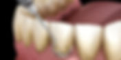 Top Reasons to Choose EZ Dental Care for Root Planing