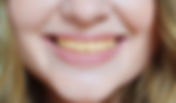 7 Everyday Habits That Are Yellowing Your Teeth and How Teeth Whitening Can Help