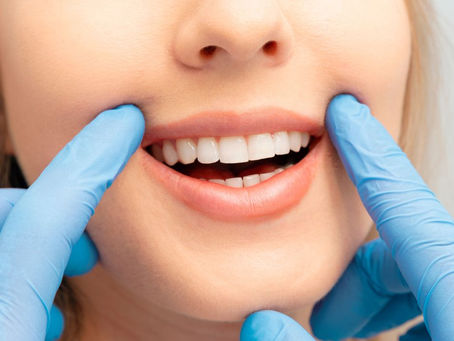 what is teeth whitening