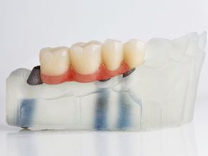 dental bridge procedure