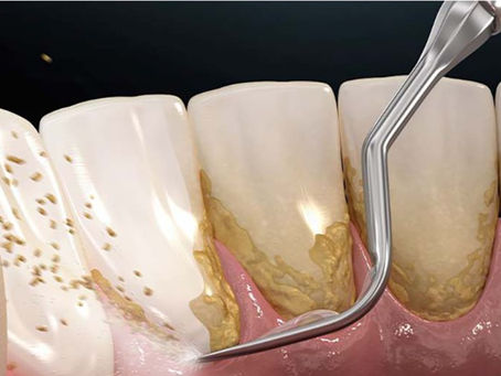 Recovery After Root Planing: Tips for Healing Faster