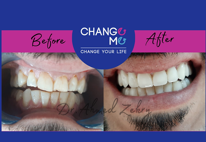 before&after veneer.png