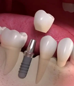 dental-implant-chiangmai-thailand.webp