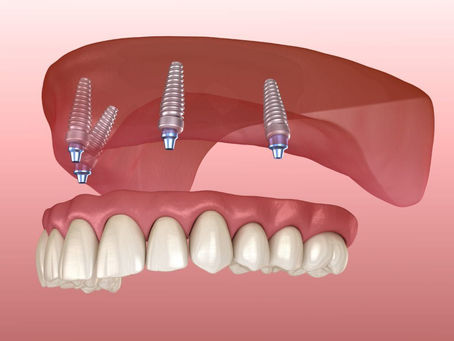 What To Look For When Choosing A Dental Implant Dentist In Nyc?