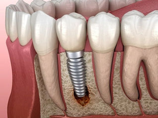 Understanding Failures: Can Dental Implants Fail?