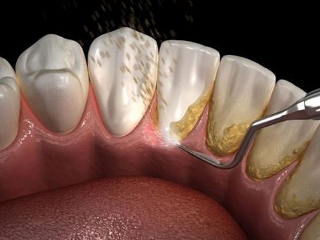 Professional Teeth Scaling and Polishing