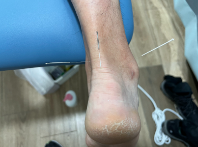 正在做針灸治療阿基里斯腱發炎