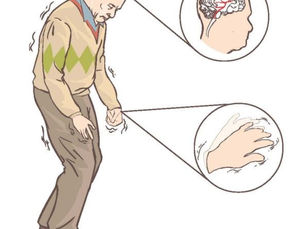 ЛІКУВАННЯ ХВОРОБИ ПАРКІНСОНА ПОКРАЩУЄ ЯКІСТЬ ЖИТТЯ