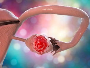 Bevacizumab treatment for patients with recurrent ovarian cancer