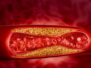 Inclisiran - A game changer in ASCVD management