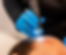 How long does hair loss treatment take in Singapore