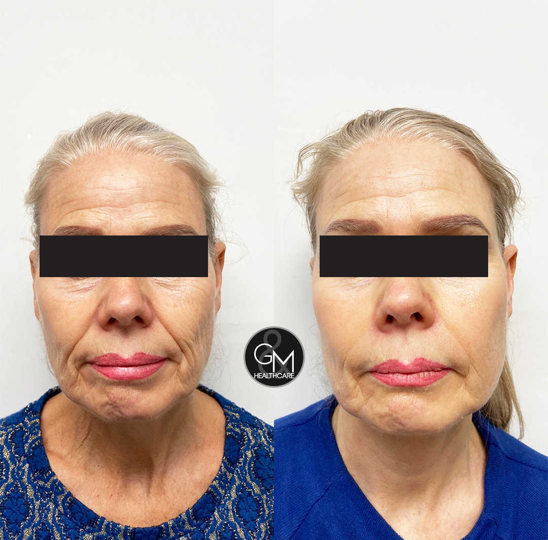 PDO Thread Lift | G&M Healthcare