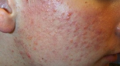 Papules.jpg