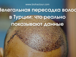 Нелегальная пересадка волос в Турции: как распознать и обезопасить себя в 2026 году