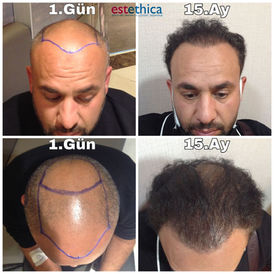 Before and after hair transplant at Esthethica Clinic, Istanbul – Day 1 of surgery and result after 15 months, 4,800 grafts