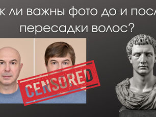 Коллаж: фото до и после пересадки волос, штамп CENSORED, справа серый античный бюст на тёмном фоне