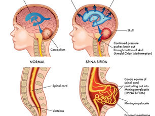 Spina Bifida